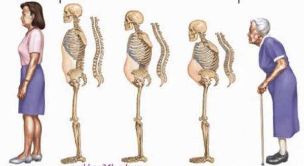 Thoái hóa xương theo độ tuổi