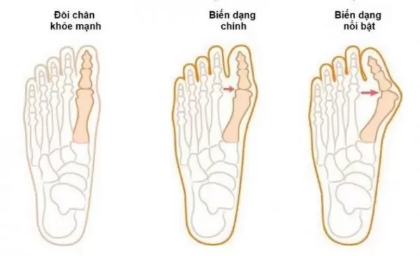 các giai đoạn biến dạng ngón chân cái