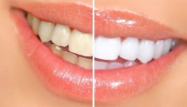 best teeth whitening products