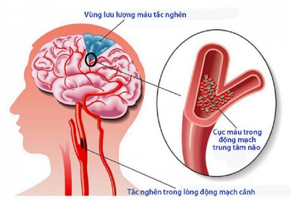 Bệnh tai biến nhẹ thường xuất hiện do tắc nghẽn máu ở não
